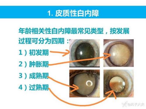 白内障手术不做可能会引起这些风险j9国际